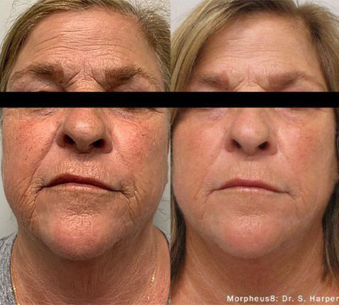 Morpheus Before and After photo by Kerin MedSpa & Laser Center in Tuckahoe, NY