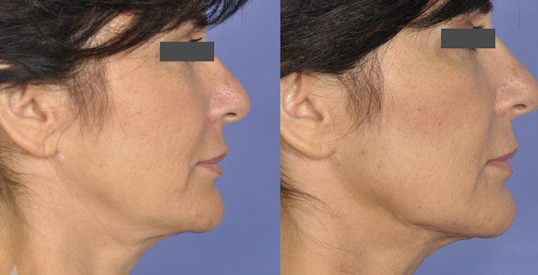 Laser Facelift Before and After photo by Kerin MedSpa & Laser Center in Tuckahoe, NY