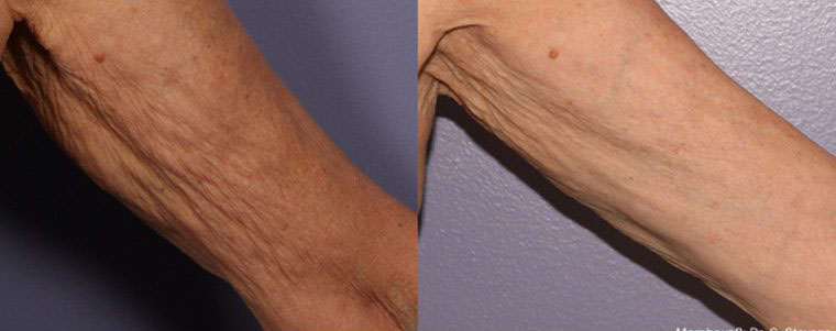 Morpheus Before and After photo by Kerin MedSpa & Laser Center in Tuckahoe, NY
