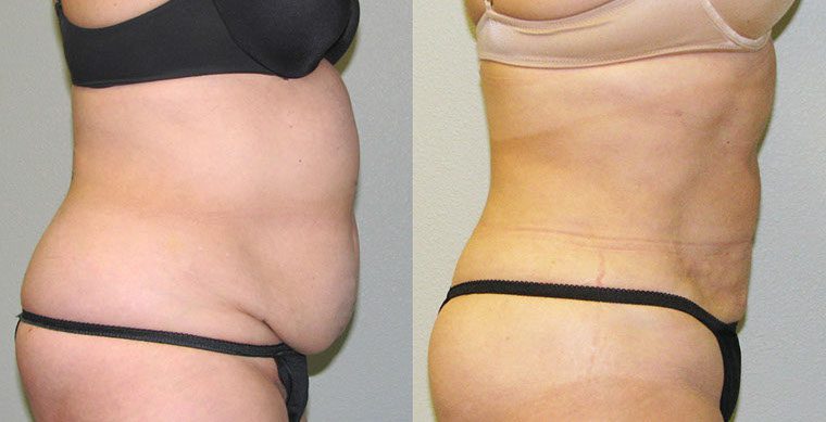 SmartLipo Triplex Before and After photo by Kerin MedSpa & Laser Center in Tuckahoe, NY