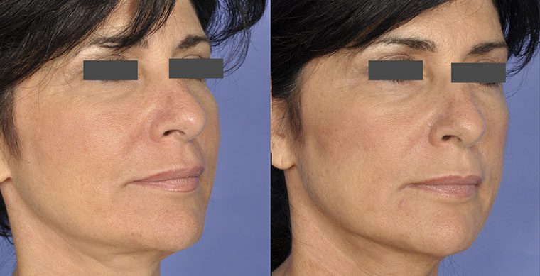 Laser Facelift Before and After photo by Kerin MedSpa & Laser Center in Tuckahoe, NY