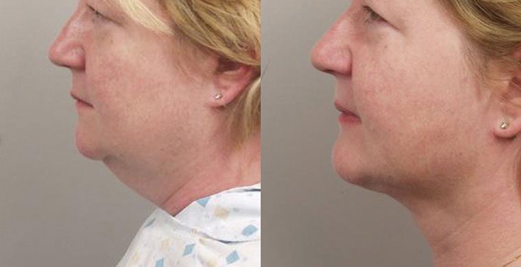 SmartLipo Triplex Before and After photo by Kerin MedSpa & Laser Center in Tuckahoe, NY