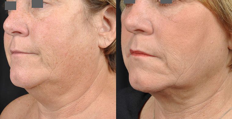 Laser Facelift Before and After photo by Kerin MedSpa & Laser Center in Tuckahoe, NY
