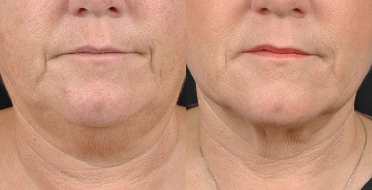 Laser Facelift Before and After photo by Kerin MedSpa & Laser Center in Tuckahoe, NY