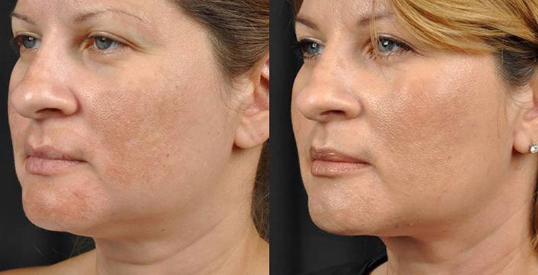 Laser Facelift Before and After photo by Kerin MedSpa & Laser Center in Tuckahoe, NY