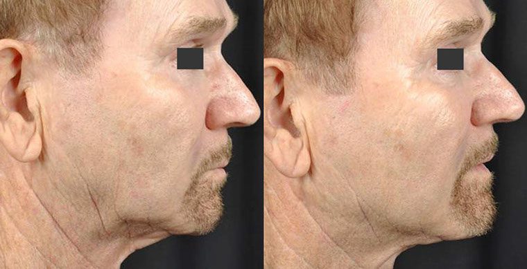 Laser Facelift Before and After photo by Kerin MedSpa & Laser Center in Tuckahoe, NY