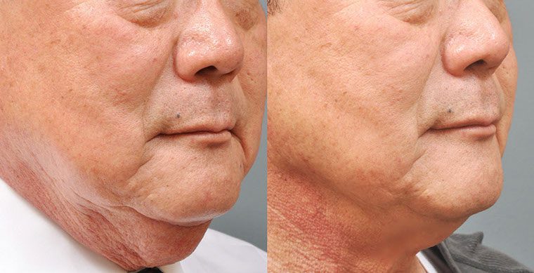 Laser Facelift Before and After photo by Kerin MedSpa & Laser Center in Tuckahoe, NY