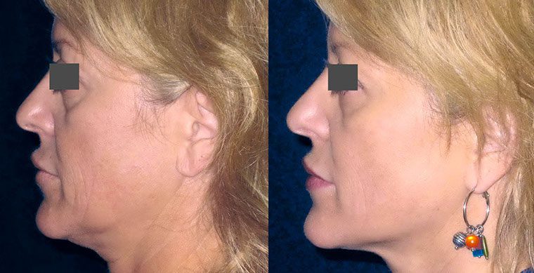 Laser Facelift Before and After photo by Kerin MedSpa & Laser Center in Tuckahoe, NY