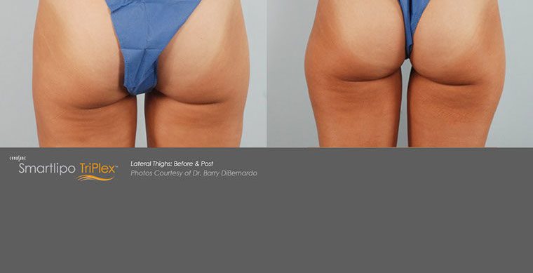 SmartLipo Triplex Before and After photo by Kerin MedSpa & Laser Center in Tuckahoe, NY