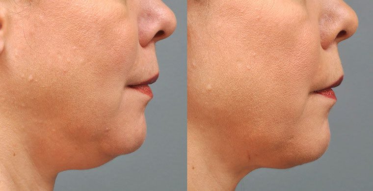 Laser Facelift Before and After photo by Kerin MedSpa & Laser Center in Tuckahoe, NY