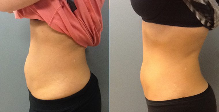 Cool Sculpting Before and After photo by Kerin MedSpa & Laser Center in Tuckahoe, NY