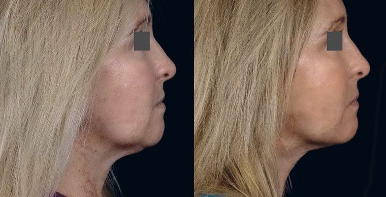 Laser Facelift Before and After photo by Kerin MedSpa & Laser Center in Tuckahoe, NY