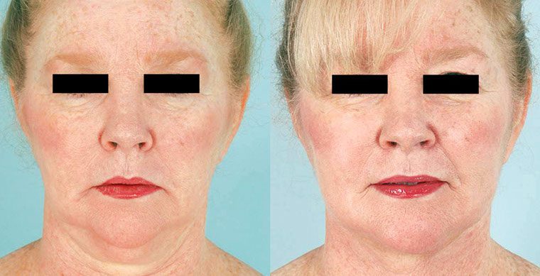 SmartLipo Triplex Before and After photo by Kerin MedSpa & Laser Center in Tuckahoe, NY