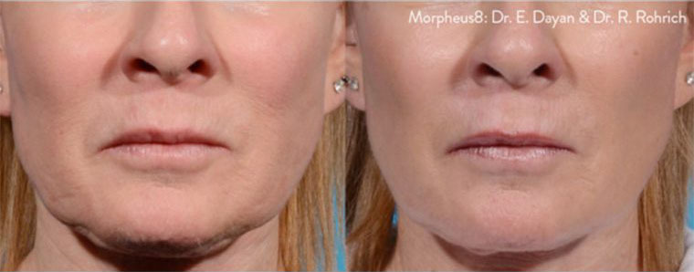 Morpheus Before and After photo by Kerin MedSpa & Laser Center in Tuckahoe, NY
