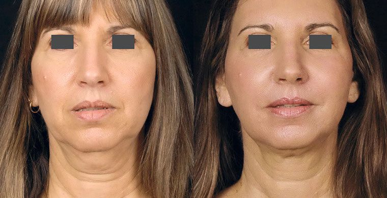 Laser Facelift Before and After photo by Kerin MedSpa & Laser Center in Tuckahoe, NY