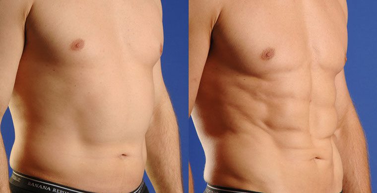 SmartLipo Triplex Before and After photo by Kerin MedSpa & Laser Center in Tuckahoe, NY