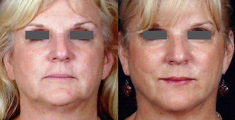 Laser Facelift Before and After photo by Kerin MedSpa & Laser Center in Tuckahoe, NY