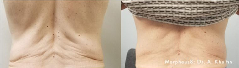 Morpheus Before and After photo by Kerin MedSpa & Laser Center in Tuckahoe, NY