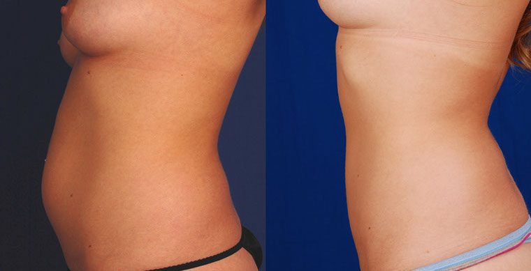 SmartLipo Triplex Before and After photo by Kerin MedSpa & Laser Center in Tuckahoe, NY