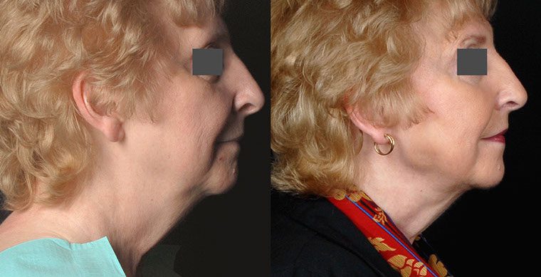 Laser Facelift Before and After photo by Kerin MedSpa & Laser Center in Tuckahoe, NY