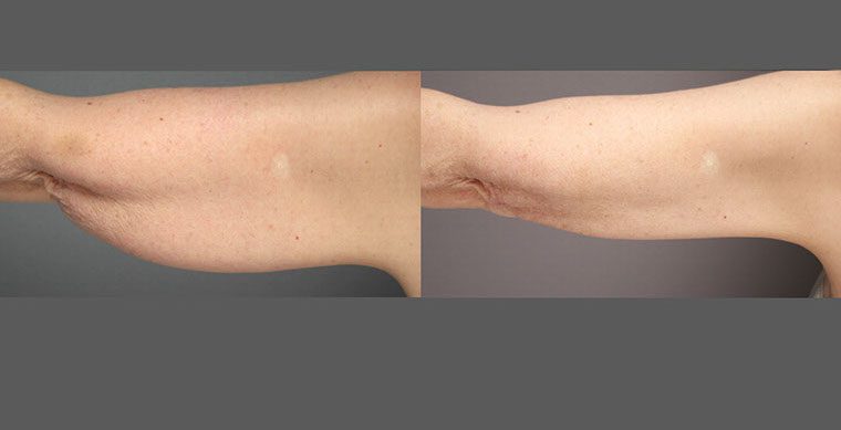 SmartLipo Triplex Before and After photo by Kerin MedSpa & Laser Center in Tuckahoe, NY
