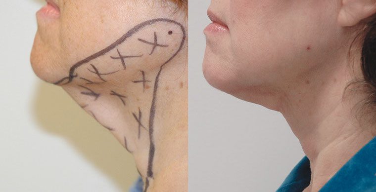 SmartLipo Triplex Before and After photo by Kerin MedSpa & Laser Center in Tuckahoe, NY