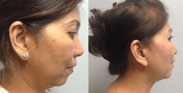 Laser Facelift Before and After photo by Kerin MedSpa & Laser Center in Tuckahoe, NY