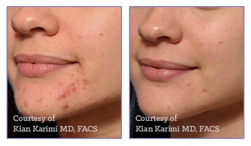 before and after microneedling at kerin medspa