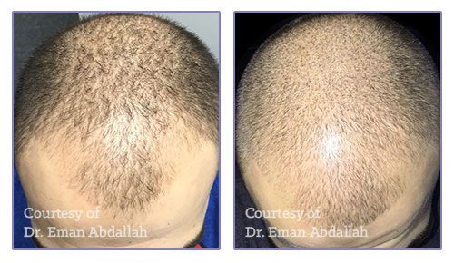 before and after microneedling at kerin medspa