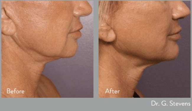 before and after morpheus at kerin medspa