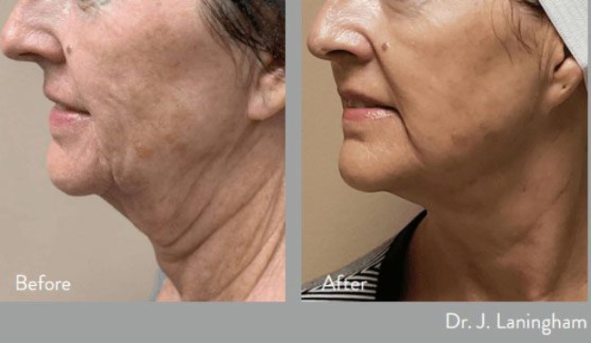 before and after morpheus at kerin medspa