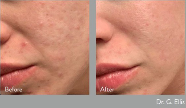 before and after morpheus at kerin medspa