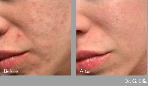 before and after morpheus body at kerin medspa