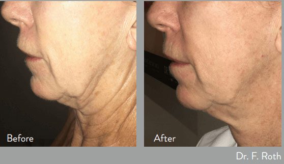 before and after morpheus body at kerin medspa