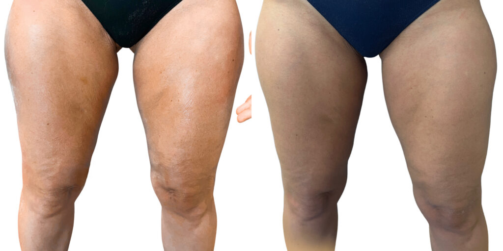 Morpheus Before and After photo by Kerin MedSpa & Laser Center in Tuckahoe, NY