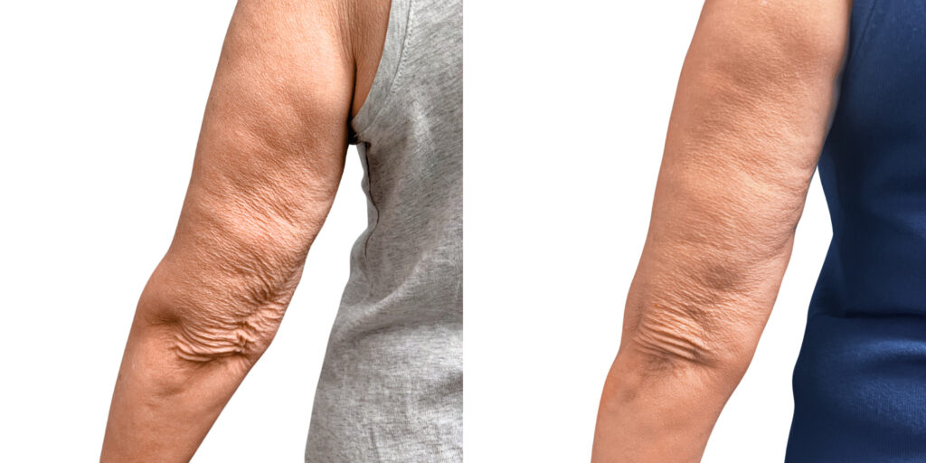 Before and After Morpheus PATIENT Back of Arms