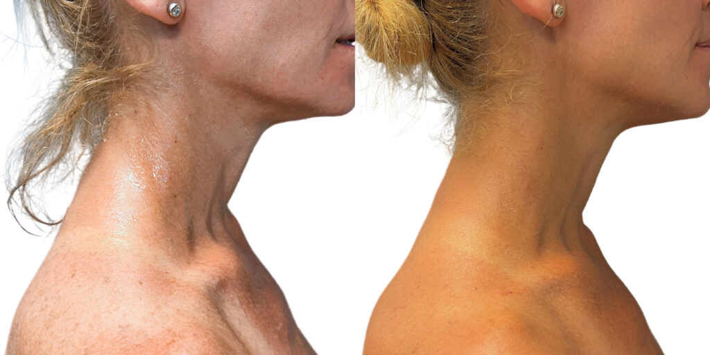 Morpheus Before and After photo by Kerin MedSpa & Laser Center in Tuckahoe, NY