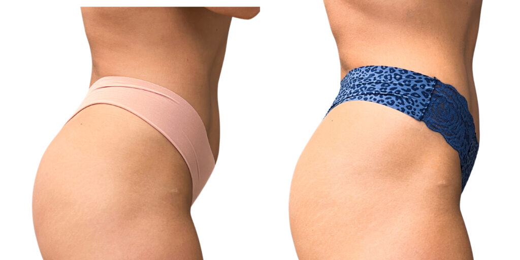 Before and After Morpheus PATIENT Abdomen side view