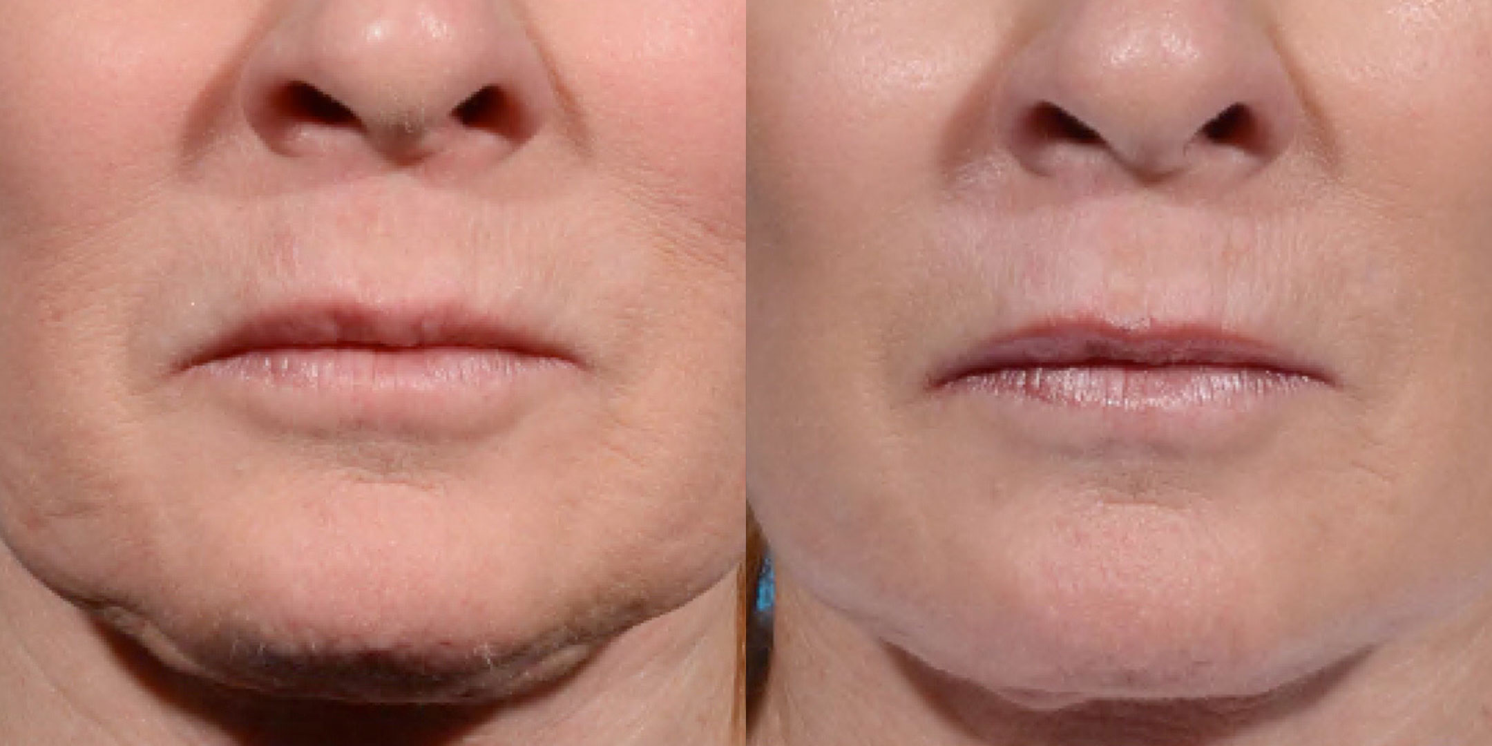 Morpheus Before and After photo by Kerin MedSpa Laser Center in Tuckahoe NY Morpheus Before and After photo by Kerin MedSpa Laser Center in Tuckahoe NY