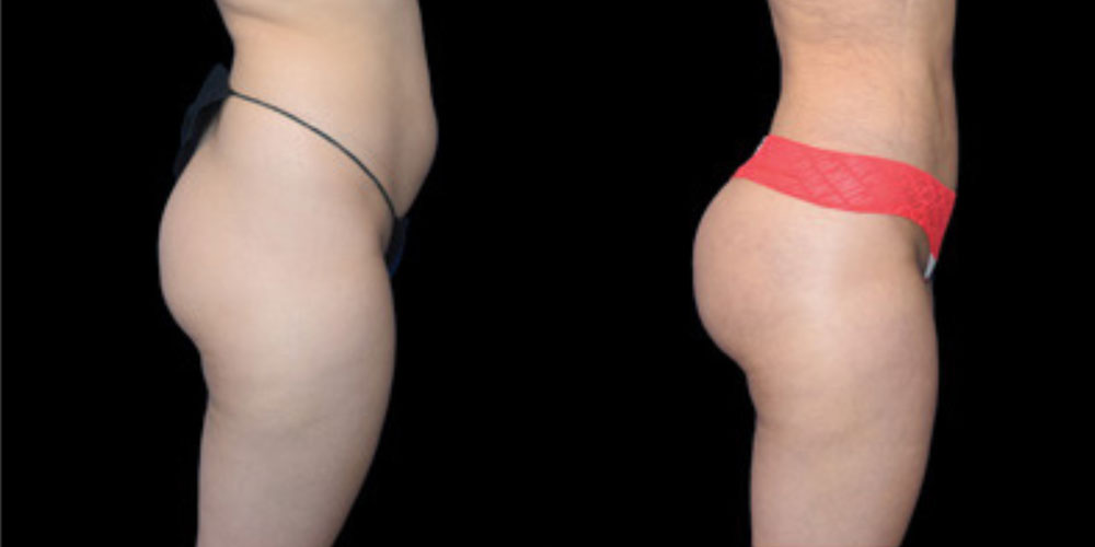 Lipo Renuvion Abdomen
