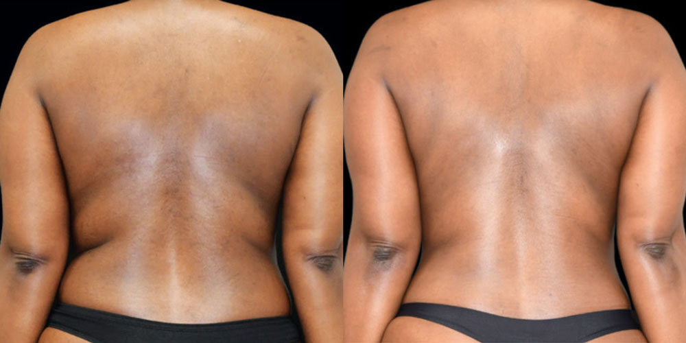 Lipo then Renuvion Back