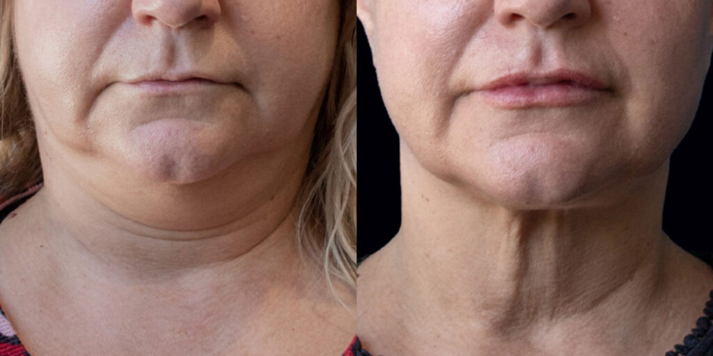 Lipo then Renuvion Neck