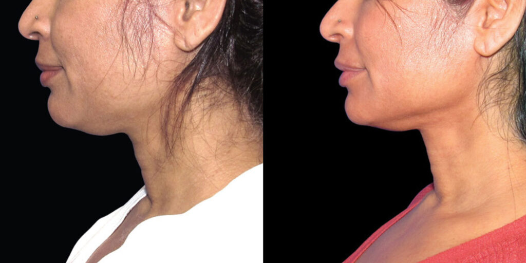 ba Lipo then Renuvion Neck