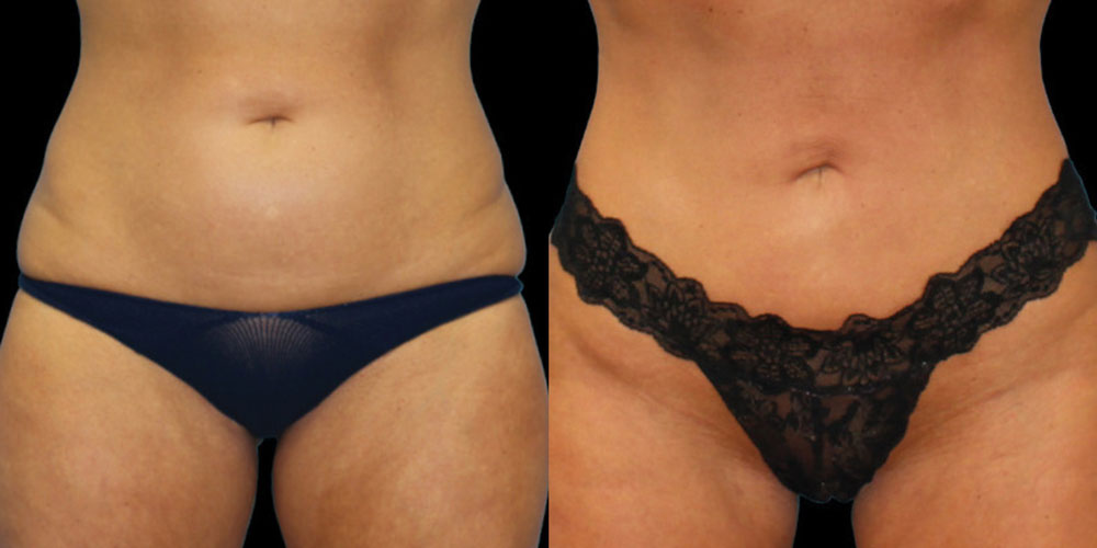 Lipo then Renuvion