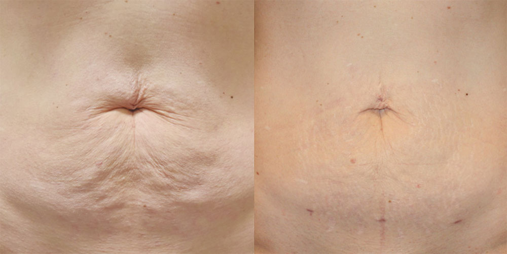 Renuvion Before & After