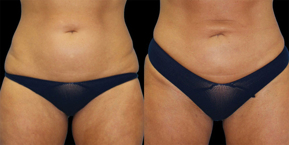 Renuvion Before & After