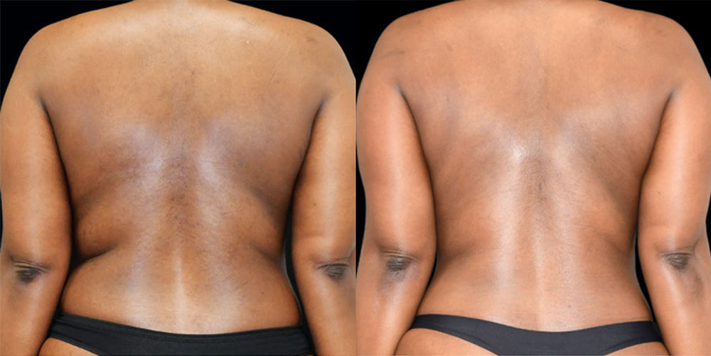 Renuvion Before & After