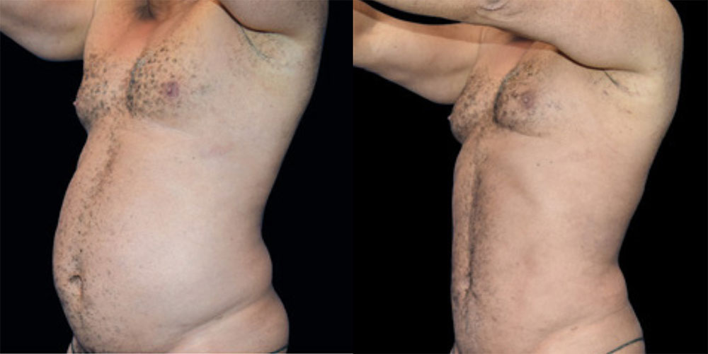 Renuvion Before & After
