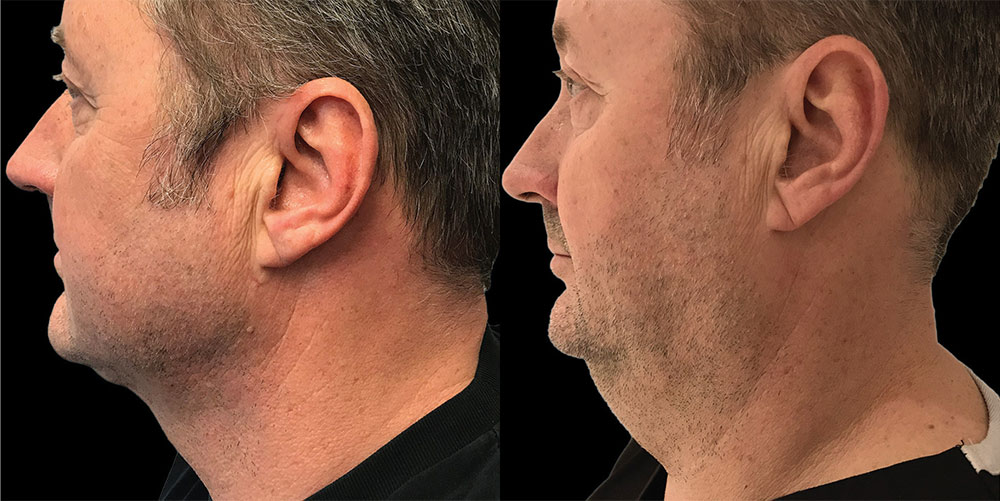 Renuvion Before & After