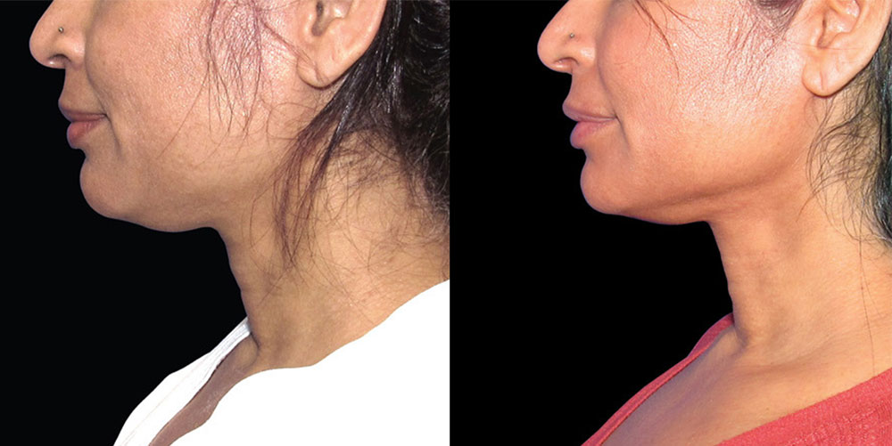 Renuvion Before & After
